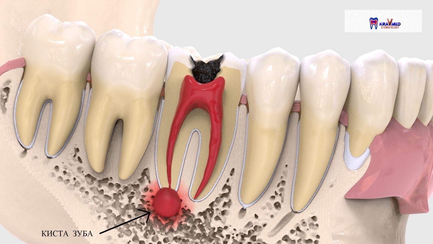 Рассосался корень зуба. Маргинальный периодонтит. Что такое периодонтит в стоматологии. Гранулема корня зуба снимок.