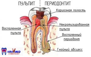 лечение пульпита постоянных несформированных зубов